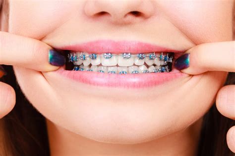 funcion de los brackets metalicos|ventajas de brackets metálicos.